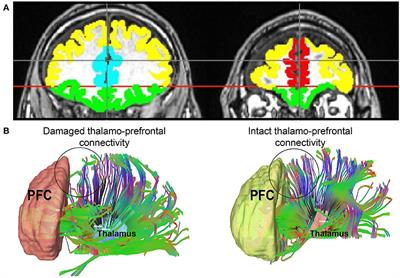 Thalamo-Prefrontal Connectivity Correlates With Early Command-Following After Severe Traumatic Brain Injury